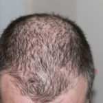 calvizie alopecia come prevenirla