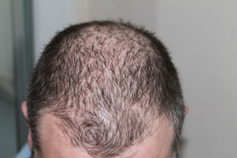 calvizie alopecia come prevenirla